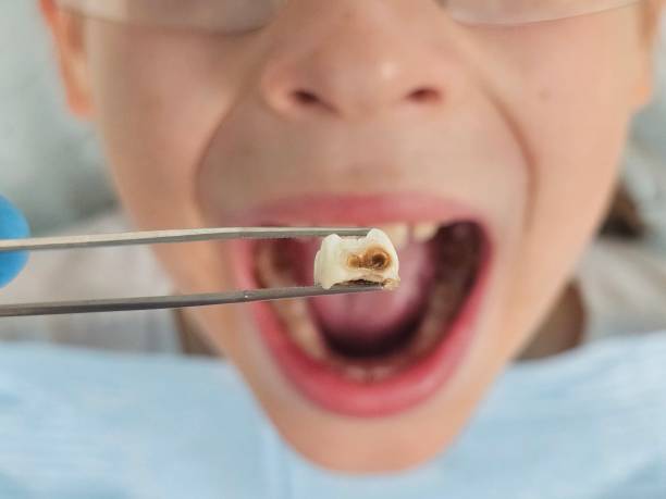 Best Urgent Tooth Repair  in Germantown, OH
